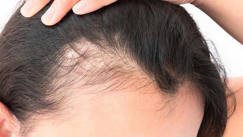 脫發(fā)圖片（alopecia）